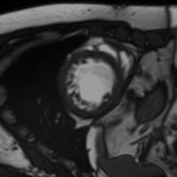 Original MRI cycle.