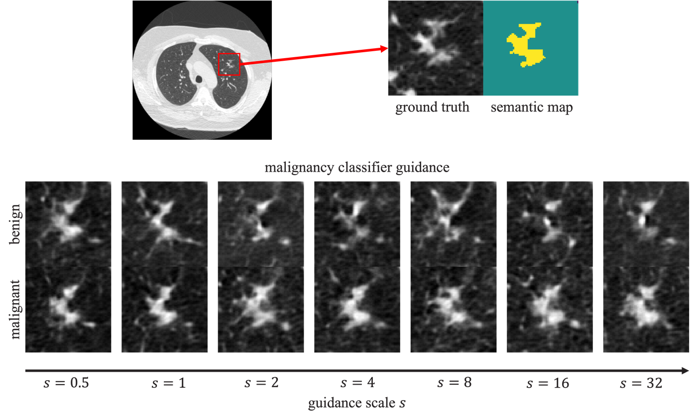 Controllable CT synthesis across inpainting classifier guidance scales.